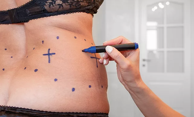 Vaser Liposuction 02