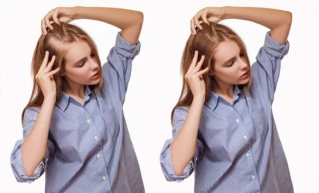 Women Hair Transplant 01