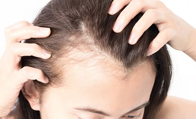 Women Hair Transplant 03
