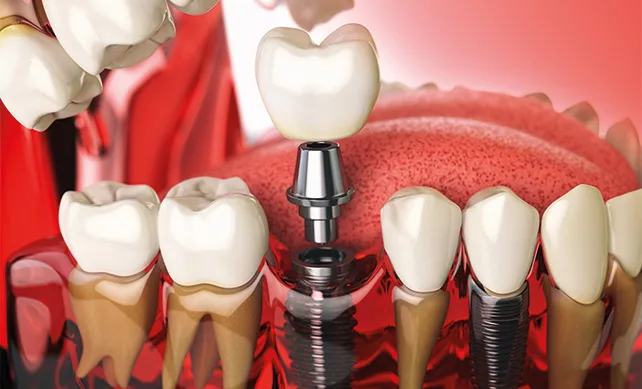 Dental Implants 02
