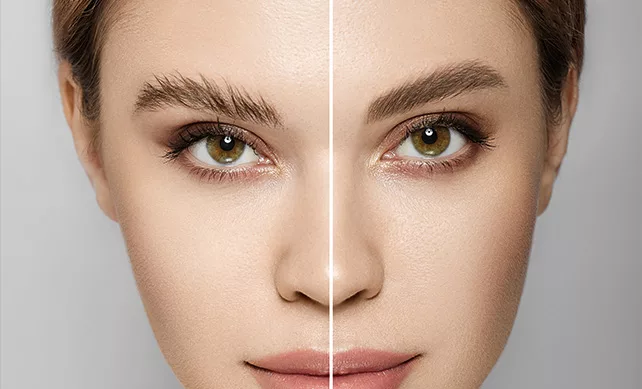 Eyebrow Transplant 02
