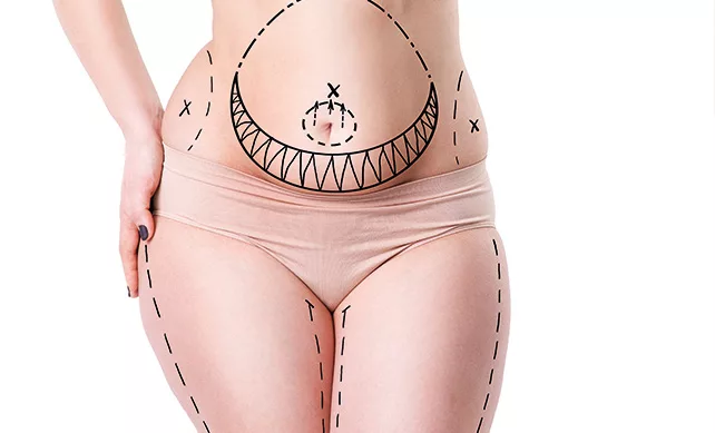 Tummy Tuck 01