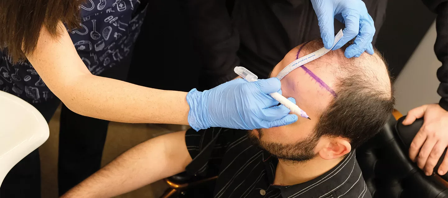 Achieve Natural Hair Restoration with Direct Implantation in Turkey USA vs. Turkey