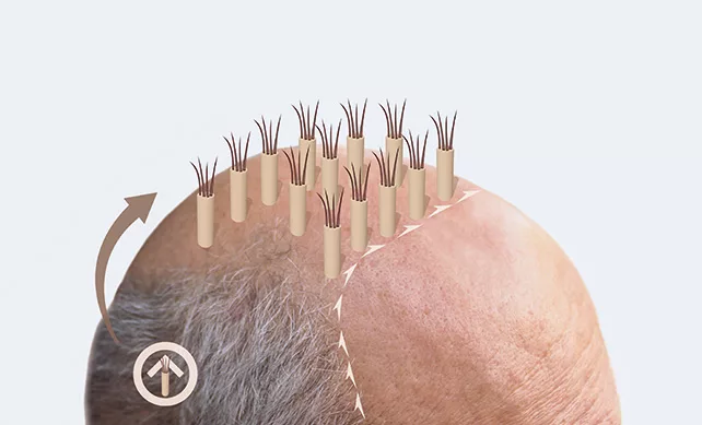 Fue Hair Transplant 01