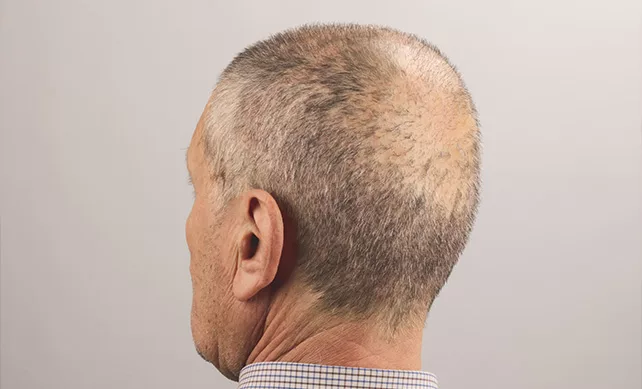 Fue Hair Transplant 02