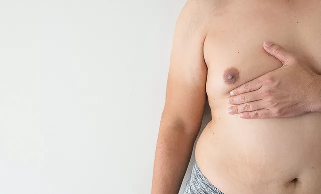 Gynecomastia 02