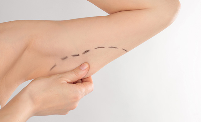 Arm Lift Surgery (Brachioplasty) 02