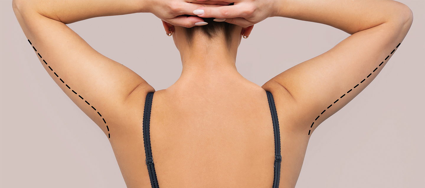 Achieve Toned Arms: A Comprehensive Guide to Arm Lift Surgery