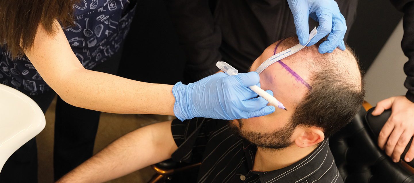 The Guide to DHI Hair Transplant