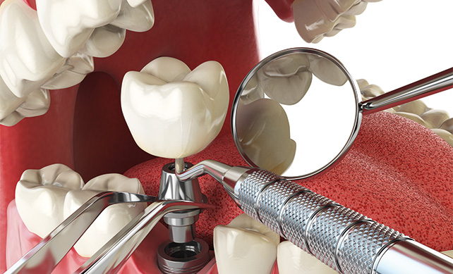 Dental Implants 04