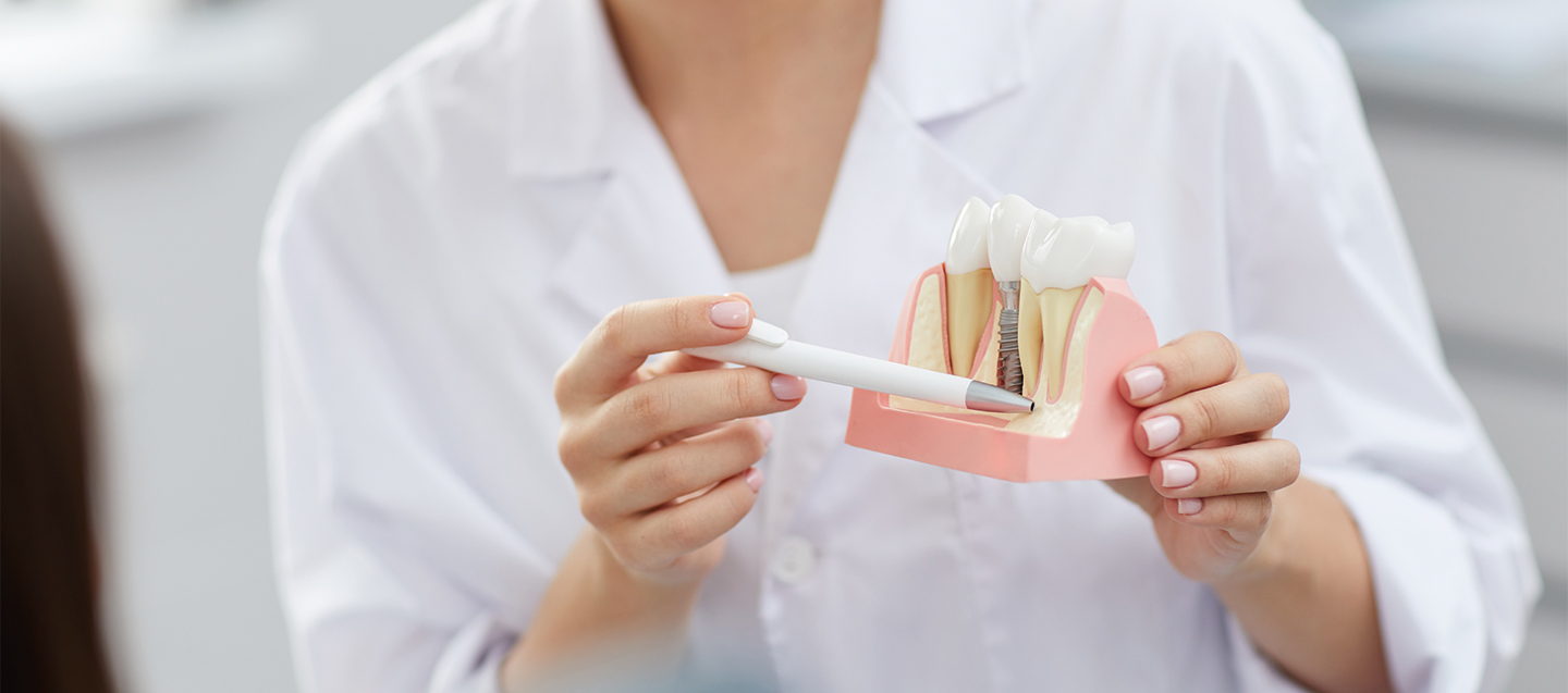 The Guide to Dental Implants