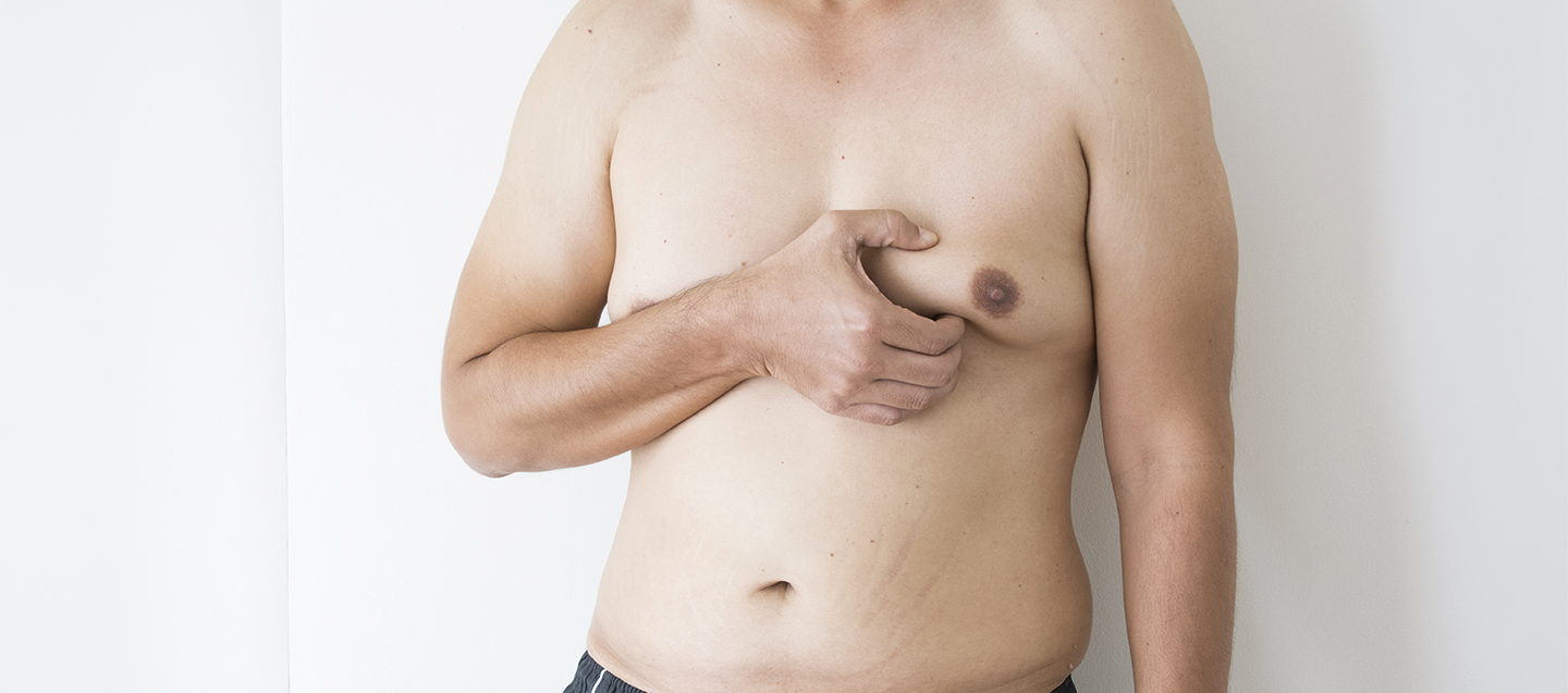 Achieve a More Masculine Chest: A Comprehensive Guide to Gynecomastia Surgery