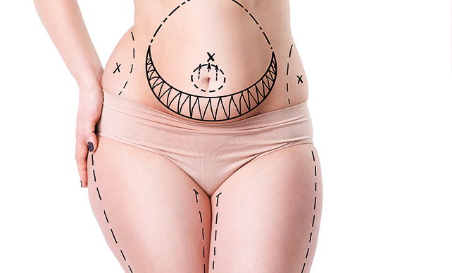 Tummy Tuck 01