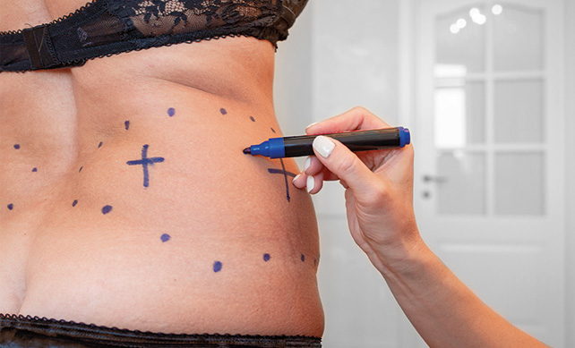 Vaser Liposuction 02