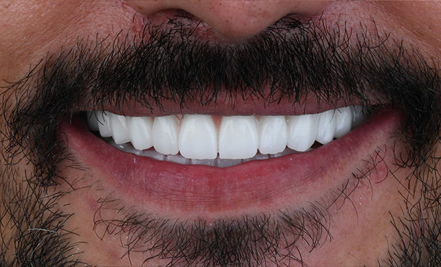 Zirconium Crown 02