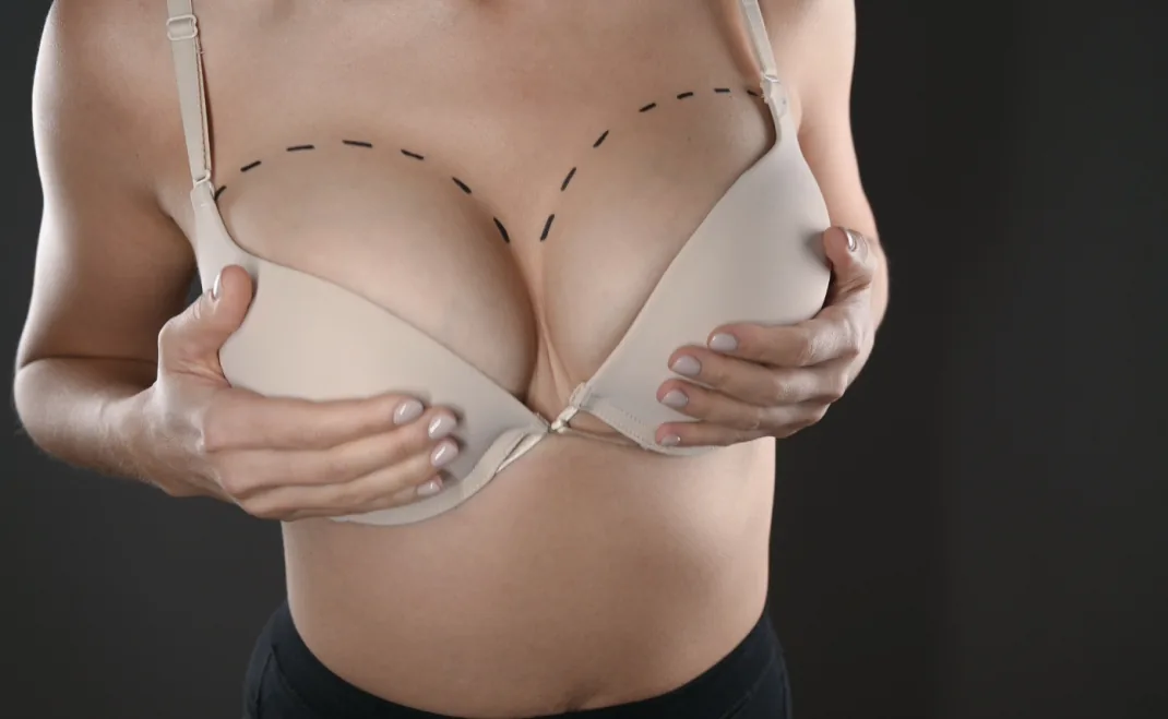 breast augmentation 1070x659
