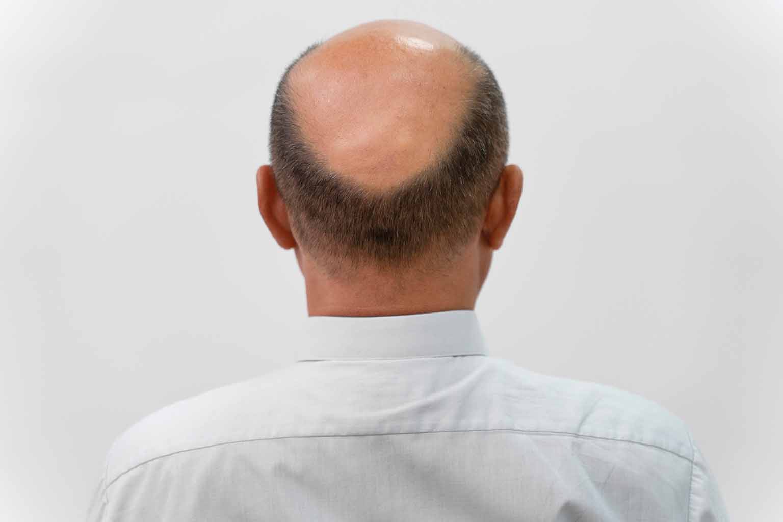 How Many Grafts Do You Need