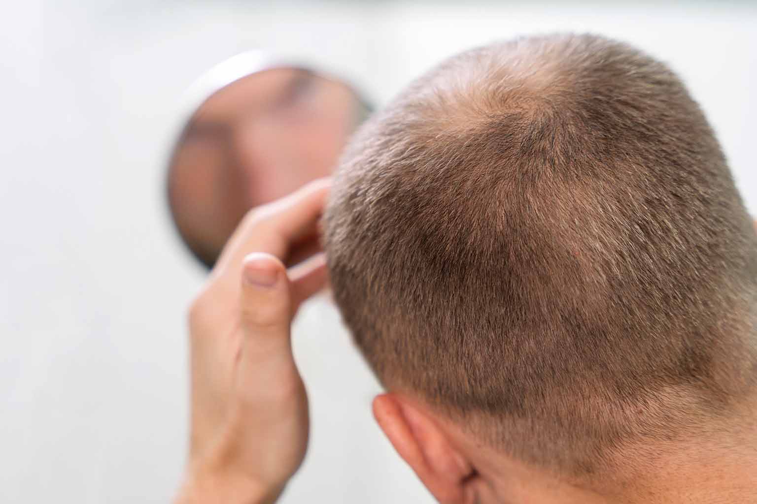 Is Hair Transplant Permanent